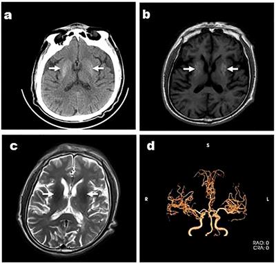 Clinical and neuroimaging characteristics of diabetic striatopathy: a case series report